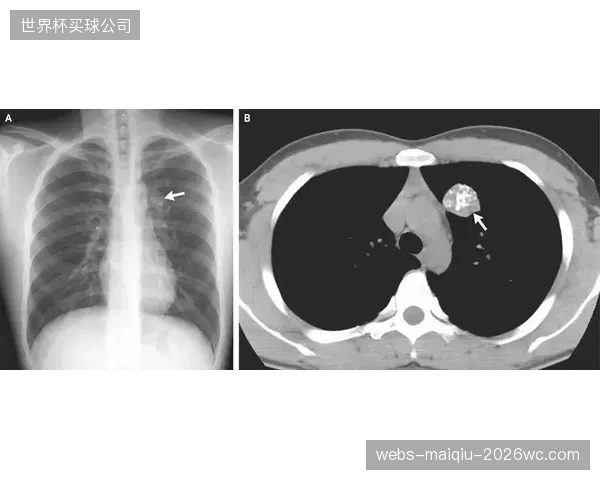 转会体检中被刻意淡化的软骨磨损为何屡屡变成烂账？